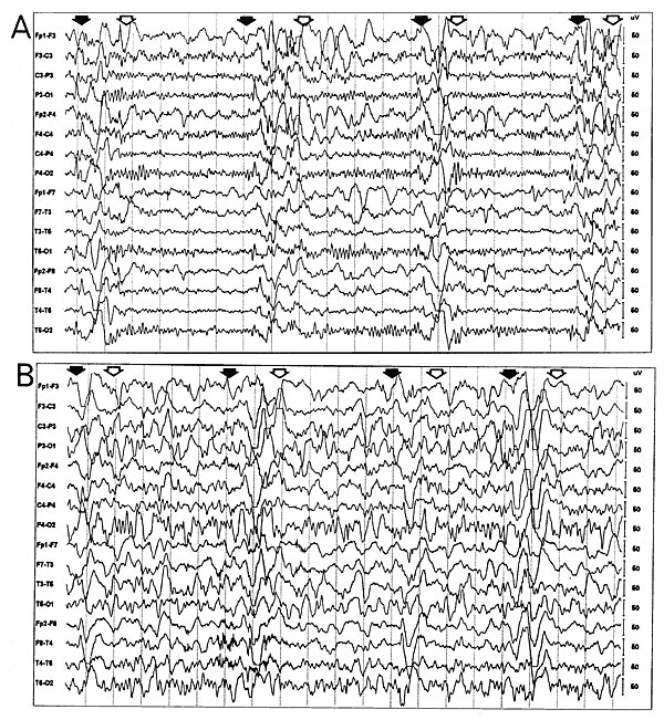 Electroencephalogram (EEG) at the time of presentation in the neurology clinic (A) and 3 months later (B). The initial EEG (A) reveals periodic bursts of high-amplitude, slow-wave complexes. (Onset of the complexes is indicated by solid arrows; offset, by open arrows.) The background rhythm is normal, except for bifrontal slowing. This "burst-suppression" pattern is highly characteristic of subacute sclerosing panencephalitis (4). EEG 3 months later, when the patient's clinical status has worsen