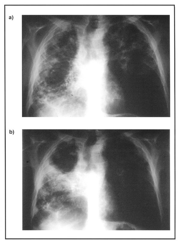 X-rays of the chest of a 58-year-old patient obtained in February 1998 (a) and April 1999 (b).