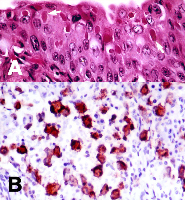 Tissue lesions from a Caspian seal with distemper. (A) Multiple intracytoplasmic, acidophilic viral inclusions in transitional epithelium of urinary bladder (arrows). Hematoxylin and eosin. (B) Immunohistochemical labeling of morbilliviral antigen in lymphoid cells in a lymph node. Avidin-biotin-peroxidase technique with hematoxylin counterstain.