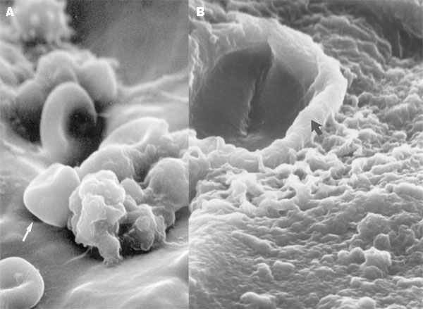 A. Scanning electron microscopy shows the presence of leukocytes and red blood cells on the tip of the ventriculo-peritoneal mass, within which coccoid cells can be visualized. The enclosing matrix material has condensed by dehydration, but the outline of the 4- to 6-µm coccoid cells (arrow), similar to those of C. immitis, can be resolved within the mass (x4,000). B. Scanning electron microscopy of the surface of the ventriculo-peritoneal shunt, showing complete colonization of the surface by a matrix-enclosed biofilm formed by the cells of C. immitis. Within the dehydration-condensed matrix of this biofilm, a hyphal element (arrow) and coccoid cells (4-6 µm) of the pathogen can be discerned (x5,000).