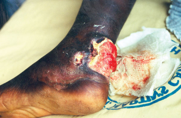 Buruli ulcer on left ankle.