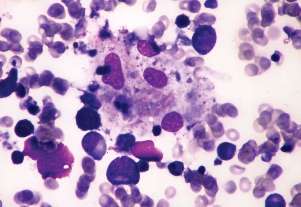 Bone marrow aspirate showing phagocytosis of neutrophil, nucleated erythrocyte, and platelets by benign histiocytes (Wright stain, x400).