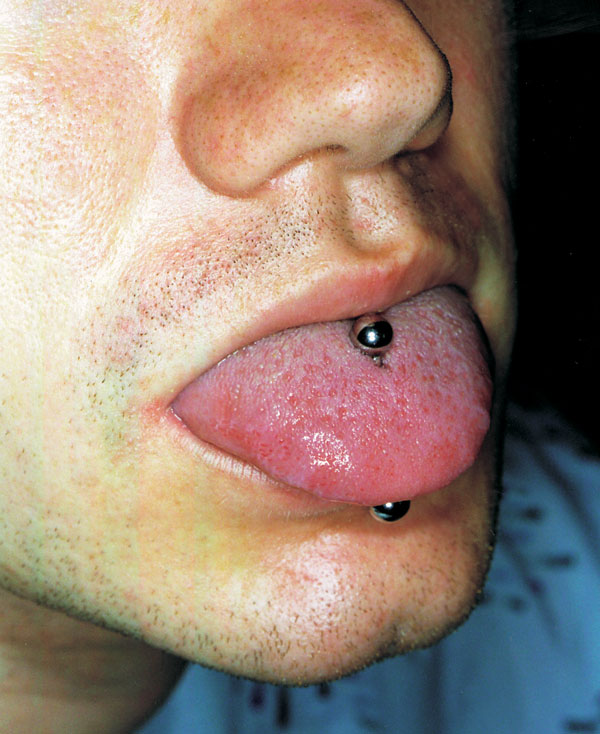 The tongue pierce of the man from the case study. The stud was bispherical metal inserted without anesthesia or preparation. Although the stud was removable, the patient had not removed it. The area around insertion was clean with no local sign of infection when the stud was removed; the tongue was not inflamed or painful.