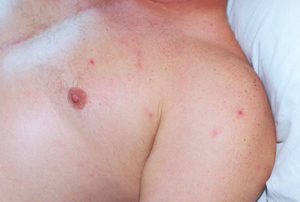 Multiple papulovesicles involving the upper trunk on a patient with rickettsialpox.