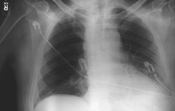 Initial chest X-ray (Case 1) showing prominent superior mediastinum and possible small left pleural effusion.