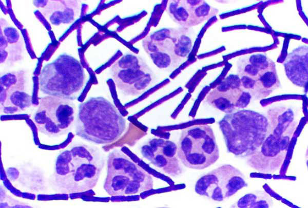 Gram stain of cerebrospinal fluid (Case 1) showing B. anthracis.
