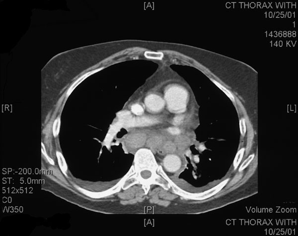 Computed tomography of chest (Case 7) showing mediastinal adenopathy and small bilateral pleural effusions.
