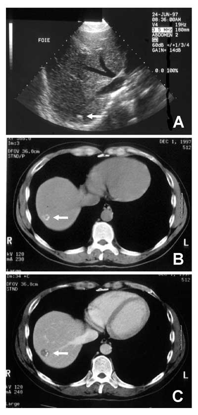 Abortive alveolar echinococcosis detected in a 44-year-old blood donor in Switzerland. A, ultrasonography of the liver demonstrates the presence of a small echodense lesion (arrow). B, a liver computed tomography scan shows a small, hypodense, apparently fully calcified lesion (arrow). C, after contrast enhancement, a very small hypodense area in the periphery of the calcified herd was detected (arrow).