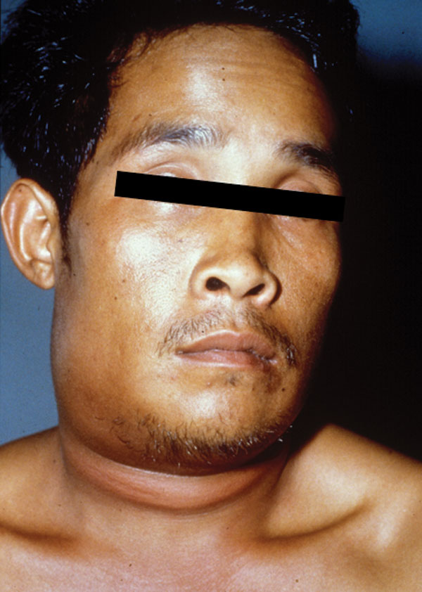 A 29-year-old man, 1 day after the onset of symptoms of oropharyngeal anthrax. Marked and painful swelling of the right side of the neck was present.