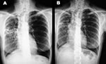 Thumbnail of Chest x-ray showing nodular lesions and lung cavitation before (A) and after (B) treatment.