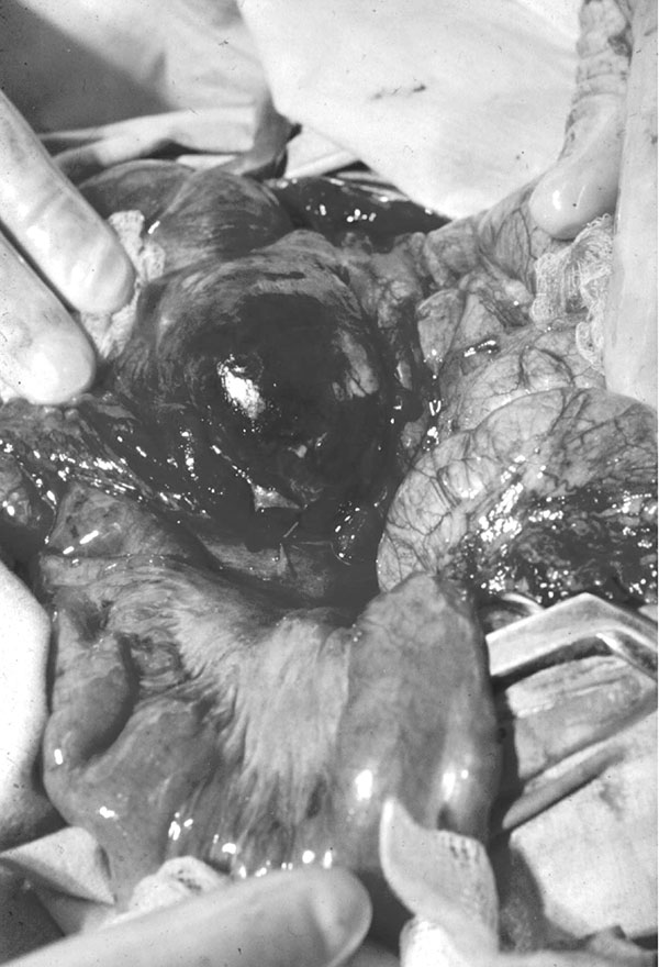 Extensive edema and hemorrhage involving the cecum in a patient with intestinal anthrax.
