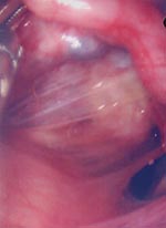 Thumbnail of Diffuse coalescences between uterus and fallopian tubes (the ovary is hidden behind the uterus).