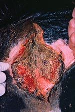 Thumbnail of Hemorrhagic vaginal necrosis characteristic of advanced bovine necrotic vulvovaginitis.
