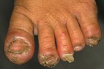 Thumbnail of Left foot of a 6-year-old girl. The first, second, third, and fifth toe are infected with Tunga penetrans. These toes are inflamed, and the second and the third toe are distorted by severe edema. The first toe shows hyperkeratosis. The nails of the first, second, and fifth toe are deformed, and the nail of the third toe is falling off. A flea is trying to penetrate the skin at the edge of the pustule on the medial side of the second toe (11 clockwise). An ulcer has formed above the