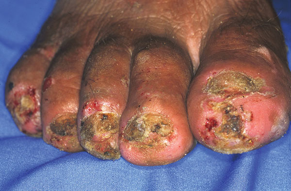 Right foot of a 50-year-old man. All nails have been lost. Embedded fleas have been manipulated by the patient, leaving innumerable sores. Desquamation and ulceration are merged. The skin tends to bleed where the stratum corneum is eroded.