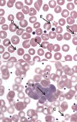 Thumbnail of Peripheral blood film, Wright stain, 1,000× (oil immersion). A, spherostomatocyte with suspect intracellular organism; B, suspect membrane-associated organism; C, microcytes with punctate discoloration; D, stomatocyte; E, poikilocyte with punctate discoloration and suspected membrane associated organism; and F, aggregate of polychromatophilic erythrocytes and suspect intracellular organism at tip of arrow.