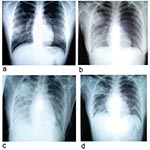 Thumbnail of Chest radiographs of index patient with severe acute respiratory syndrome (SARS). a, day 5 of symptoms; b, day 10; c, day 13; d, day 15.