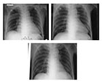 Thumbnail of A, radiograph on admission; B, radiograph on day 5 of hospital stay; C, radiograph on day 7 of hospital stay.