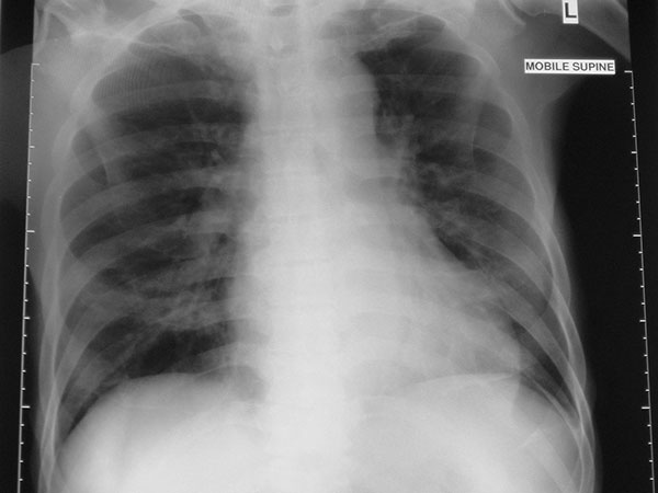 Radiograph on day 11 of hospital stay (day 14 after contact with a SARS patient).