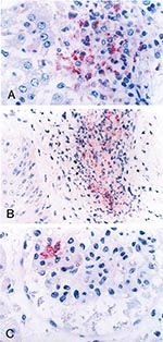 Thumbnail of Immunohistochemical localization of spotted fever group rickettsial antigens in various tissues of a patient with fatal spotted fever rickettsiosis, by immunoalkaline phosphatase stain with naphthol phosphate–fast red substrate and hemotoxylin counterstain. Rickettsiae and rickettsial antigens (red) in Kupffer cells in liver (A), perivascular infiltrates in skin (B), and glomerular endothelium in kidney (C) (naphthol–fast red stain with hematoxylin counterstain; original magnificati