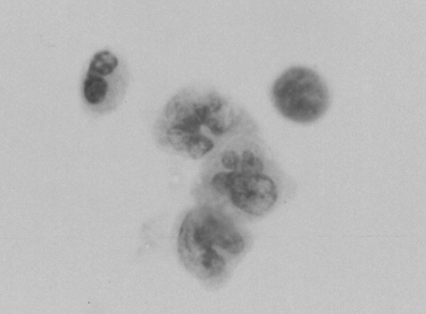 Three Mollaret-like cells are present (center), with a neutrophil (upper left) and a lymphocyte (upper right) in cerebrospinal fluid from a patient with West Nile Virus encephalitis, confirmed by reverse transcription–polymerase chain reaction and serologic testing (Papanicolaou stain; magnification x 500).