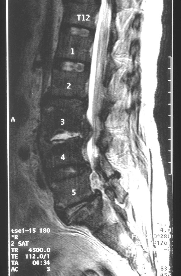 Magnetic resonance imaging scan of spine showing features compatible with discitis involving L3/L4 with surrounding paravertebral and psoas inflammation and epidural abscess.