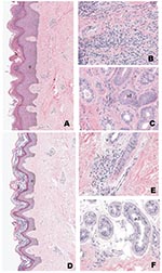 Thumbnail of Representative sample of skin punch biopsy specimens from patients with lymphedema before (A, B, C) and after (D, E, F) 1 year of basic lymphedema management. Pretreatment abnormalities of the epidermis (e), which include increased number of epithelial cells (acanthosis and epidermal hyperplasia) and thickening of the keratin (k) layer, were improved after treatment (compare first [A] and second [D] biopsies from same patient). Also noted is thickening of collagen bundles (*) in the