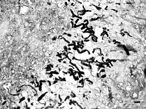 Presence of numerous, broad (3−9 μm in diameter), irregular, septate hyphae in a pyogranulomatous dermatitis (Gomori methenamine silver stain). Bar = 15 μm.