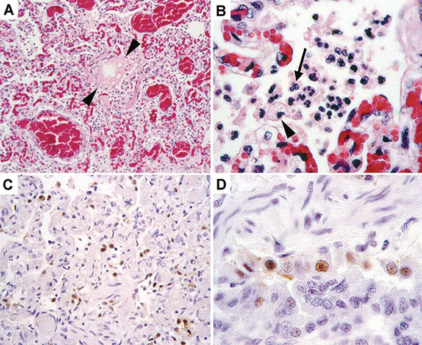 Histopathologic and immunohistochemical evidence of avian influenza A (H5N1) virus in leopard lung. A) Diffuse alveolar damage in the lung: alveoli and bronchioles (between arrowheads) are flooded with edema fluid and inflammatory cells. B) Inflammatory cells in alveolar lumen consist of alveolar macrophages (arrowhead) and neutrophils (arrow). C) Many cells in affected lung tissue express influenza virus antigen, visible as brown staining. D) Expression of influenza virus antigen in a bronchiol
