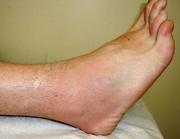 Patient 1: ankle swelling, pain, tenderness, erythema, and warmth on day 10 of illness.