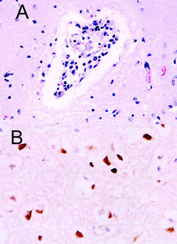 Histopathologic and immunohistochemical evidence of H5N1 virus in tiger: A) Mild multifocal nonsuppurative encephalitis; B) Influenza A virus antigen in nuclei and cytoplasm visible as brown staining.