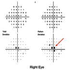 Thumbnail of Humphrey visual fields of patient 9 at 1 week after onset of visual symptoms. Central scotoma of the right visual field is denoted as black squares (red arrow).
