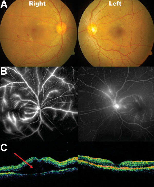Fundal photos, fundal fluorescein angiography and optical coherence tomography (OCT) of patient 9. A) areas of blot hemorrhages temporal to the right fovea. B) bilateral dye leakage from the retinal veins, more severe on the right than left. C) OCT gives a 2-dimensional graphic representation of a cross-section of the macular region. The area marked with the red arrow marks the site of exudative retinal detachment. Both sides have marked retinal thickening (edema). Photo: Ken Thian.