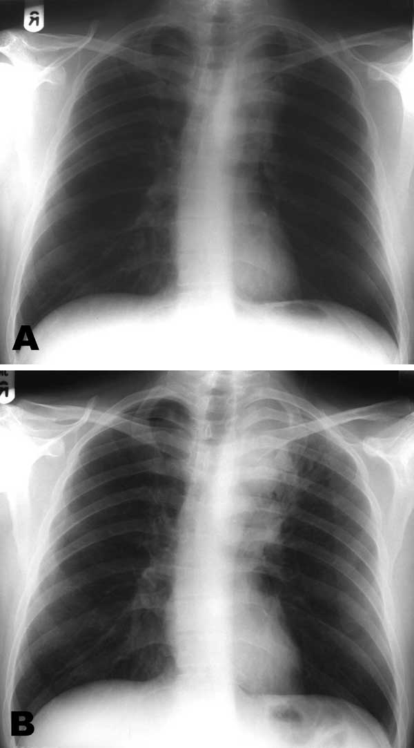 Chest radiographs at initiation of A) highly active antiretroviral therapy (HAART) showing left hilar mass; and B) after 9 weeks of HAART and antituberculosis treatment, suggesting enlargement of the hilar mass consistent with immune restoration disease. (The radiograph has been flipped horizontally to aid comparison).