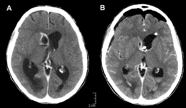 Brain abscess caused by Scedosporium apiospermum (patient 2). A) Images from contrast-enhanced computed tomographic scan show a ring-enhancing lesion in the head of the nucleus caudatus (2 × 1.5 cm) bulging in the right lateral ventricle with concomitant aresorptive hydrocephalus. B) Control computed tomographic scan after surgical drainage and placement of ventricle-peritoneal drainage.