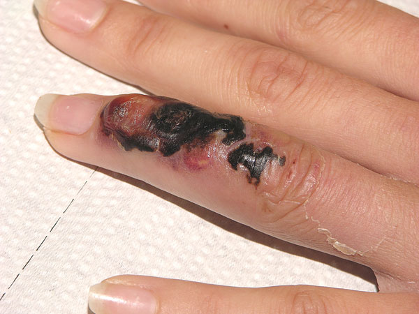 Initial skin lesion with black crust and red border, suggestive of cutaneous anthrax. By the time the picture was taken, the massive edema of hand and arm had subsided.
