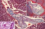 Thumbnail of Linguatula serrata nymphs in lung tissue. Main panel shows the parasite's serrated nature and the cuticular spines (magnification ×200, Masson trichrome stain). Right upper inset, pulmonary nodule with prominent fibrotic reaction and shed cuticle around 1 nymph (magnification ×200, Masson trichrome stain). Left lower inset, detailed view of 1 parasite hook (magnification ×630, hematoxylin and eosin stain).