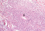 Thumbnail of Fibrinoid necrosis of a vessel in the dermis (arrow) with perivascular inflammatory infiltrates mainly composed of polymorphonuclear leukocytes (hematoxylin-eosin-saffron; original magnification ×250).