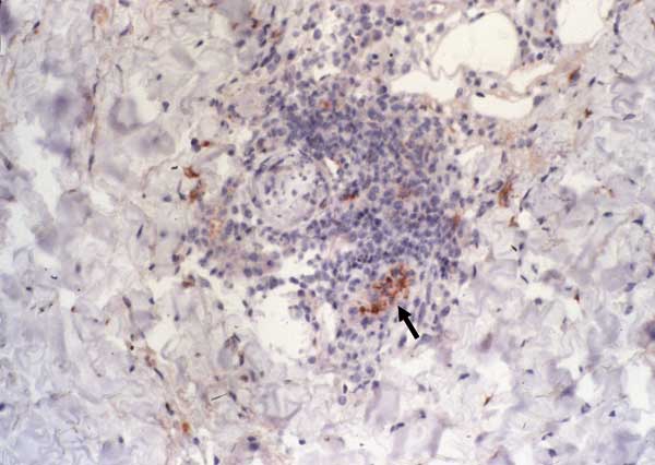 Immunohistochemical detection of Rickettsia africae in the inoculation eschar of a patient with African tick-bite fever. Note the location of the bacteria in the endothelial and inflammatory cells of a blood vessel in the dermis (arrow) (monoclonal rabbit anti-R. africae antibody used at a dilution of 1:1,000 and hematoxylin counterstain; original magnification ×250).