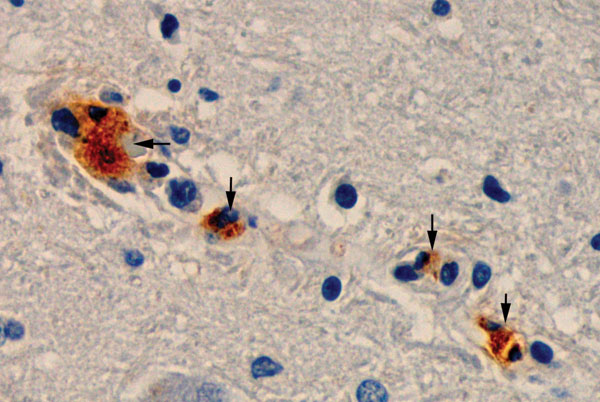 Immunohistochemical analysis shows the presence of spotted fever group rickettsiae (brown) in vessels of brain of a patient with fatal Rocky Mountain spotted fever (magnification ×400).