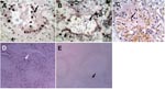 Thumbnail of Terminal deoxynucleotidyl transferase–mediated dUTP-biotin nick end-labeling staining showing numerous apoptotic alveolar epithelial cells in lung of patient B (A) and leukocytes in lung of patient A (B). C) Lung tissue from a patient with pneumonia caused by human influenza A (H5N1) virus showing apoptosis only in leukocytes. D) Spleen of patient B showing numerous apoptotic cells. E) Normal spleen tissue showing only a minimal level of apoptosis. Apoptotic cells are stained dark blue and an apoptotic cell in each panel is indicated by an arrow. Magnification ×400 in A, B, and C; ×100 in D and E.