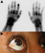 Thumbnail of Clinical findings in patients. A) Bone scintigraphy of the wrists and hands showing an intense focus of technetium-99m–labeled methylene diphosphonate tracer uptake, particularly on the left side in the left metacarpophalangeal, wrist, and the first distal interphalangeal joints in a 73-year-old man who returned from Reunion with a severe viremic chikungunya virus (CHIKV) infection. B) Conjunctivitis in a 31-year-old woman who returned from Mayotte, French Comoros, with a severe vir