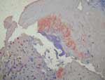 Thumbnail of Immunohistochemical demonstration of bartonellae in the mitral valve with peroxidase-conjugated polyclonal rabbit anti–Bartonella sp. antibodies. The organisms stain dark orange against the hematoxylin counterstain; original magnification ×200.