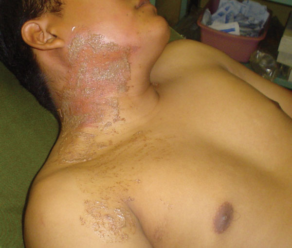 El Salvadorian infantry soldier (commando) with the characteristic rash seen after an encounter with the “pissing beetle” while sleeping.