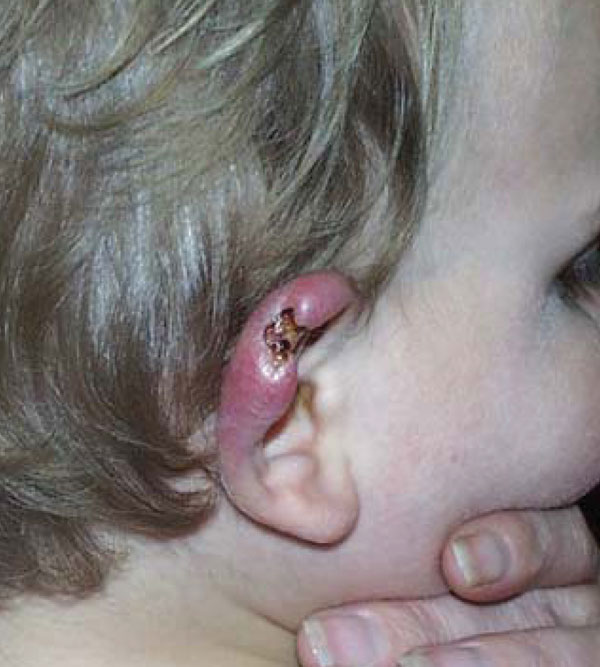 Ear of an 18-month-old child with culture- and PCR-confirmed Buruli ulcer who briefly visited St. Leonards, Australia, in 2001 (Figure 2). The initial lesion resembled a mosquito bite or that of another insect.