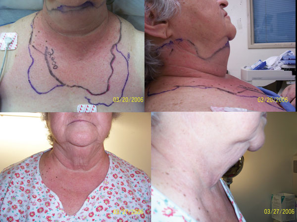 Top, anterior and lateral views of patient on day 1 of receiving antimicrobial drugs, demonstrating neck erythema and edema. Bottom, anterior and lateral views of patient on day 8 of receiving antimicrobial drugs, demonstrating resolution of neck erythema and edema.