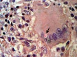 Thumbnail of Histiocytic granuloma with lymphocytes and multinucleated giant cells and an encapsulated intracytoplasmic mucicarmine-positive structure identified as a Cryptococcus sp. (arrow) (hematoxylin and eosin– and Mayer mucicarmine–stained, magnification 400×).