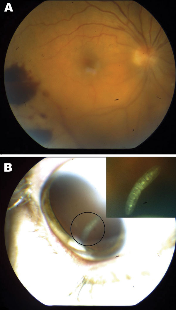 Figure 1&nbsp;-&nbsp;A) Retinal hemorrhages visible on funduscopic examination of right eye of a 41-year-old woman, Nunavut, Canada, with ophthalmomyiasis intern). B) Segmented 3-mm larva with a cylindrical body, no visible spines, and indistinguishable anterior and posterior ends in the vitreous cavity, corresponding to the first instar of Hypoderma tarandi.