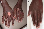 Thumbnail of Infiltrated lesions on the patient's hands A) before and B) 70 days after treatment began.