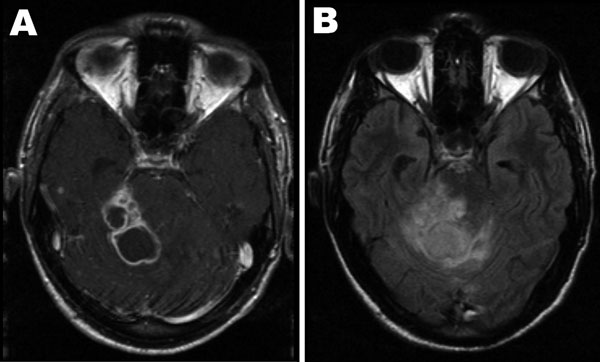Axial brain magnetic resonance imaging at the level of the cerebellum performed 6 weeks after initial consultation. A) Contrast-enhanced T1 weighted image showing several ring-enhancing lesions in the right cerebellar hemisphere and the right cerebellar peduncle. B) The corresponding fluid attenuation inversion recovery image illustrates the extensive perifocal edema exerting a severe mass effect through compression and displacement of the fourth ventricle with consecutive enlargement of the lateral ventricle.